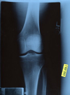 1 4kc. Adam's knee X-ray 1