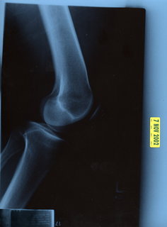 2 4kc. Adam's knee X-ray 2