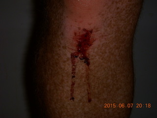 5 907. my knee after a bike fall