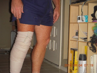 20 9f3. two days after my knee surgery