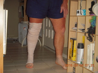21 9f3. two days after my knee surgery