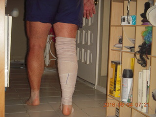24 9f3. two days after my knee surgery