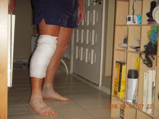 25 9f3. two days after my knee surgery