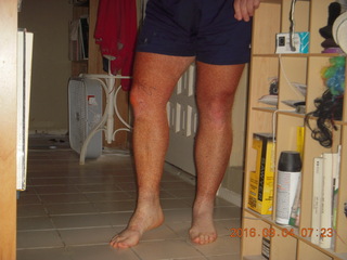 26 9f3. two days after my knee surgery