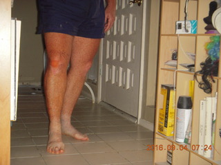 27 9f3. two days after my knee surgery