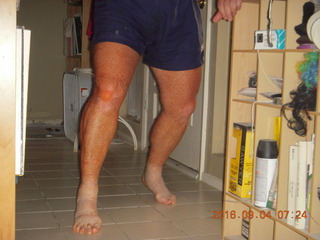 28 9f3. two days after my knee surgery