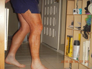29 9f3. two days after my knee surgery