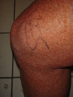 31 9f3. two days after my knee surgery