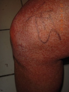 32 9f3. two days after my knee surgery