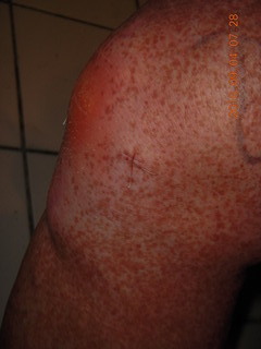 33 9f3. two days after my knee surgery