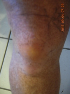 34 9f3. two days after my knee surgery