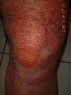 35 9f3. two days after my knee surgery