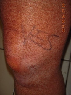36 9f3. two days after my knee surgery