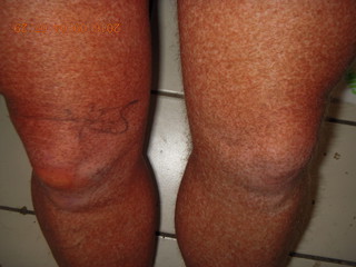 37 9f3. two days after my knee surgery