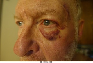 my post-surgery black eye