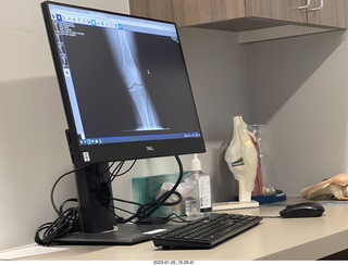 51 a1p. my knee x-ray
