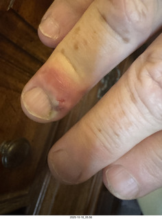 Adam's infected finger