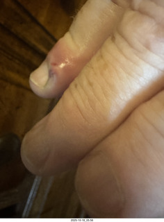 Adam's infected finger
